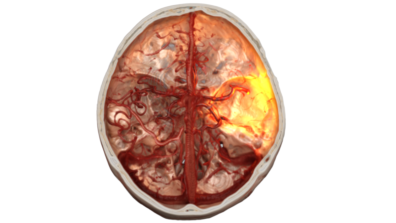 Visualisation médicale des vaisseaux cérébraux ciblés par une thrombectomie robotisée