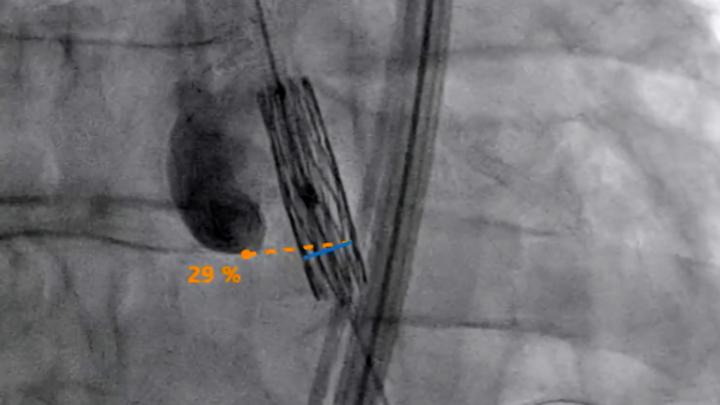 Robot TAVIPILOT de Carvolix pour le positionnement assisté des valves cardiaques